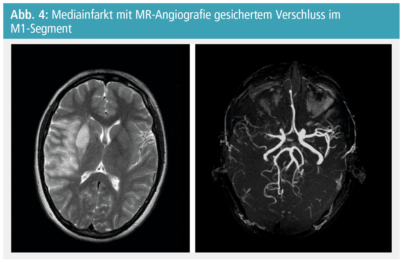 Was Sind Läsionen Im Gehirn www.medmedia.at
